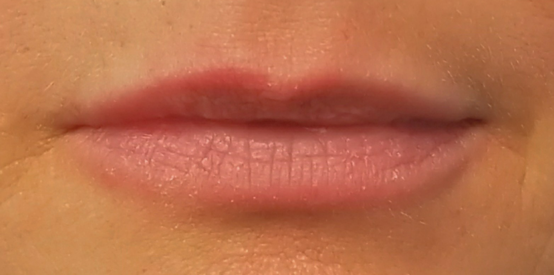 Lip Filler 1 After - Tannan Plastic Surgery