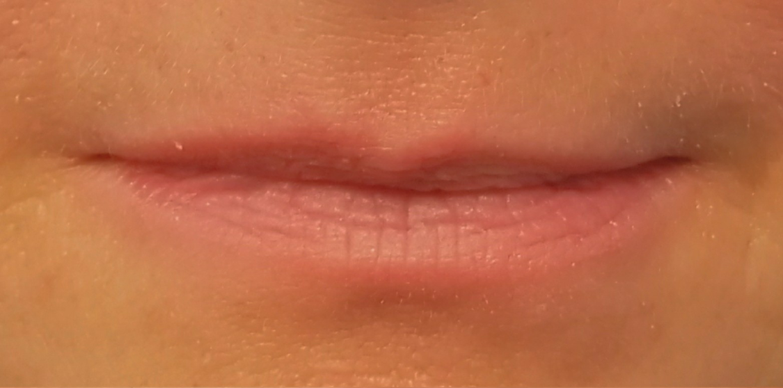 Lip Filler 1 Before - Tannan Plastic Surgery