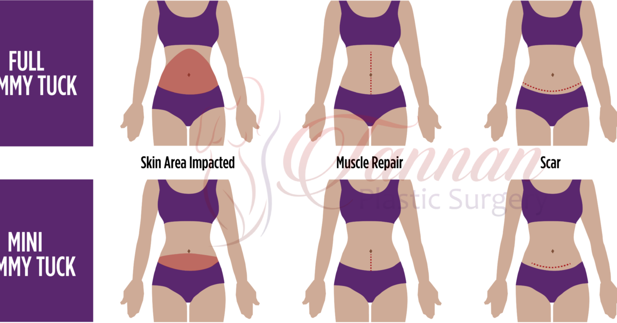 What Can I Do About My C-Section Scar and Pooch? - Tannan Plastic Surgery
