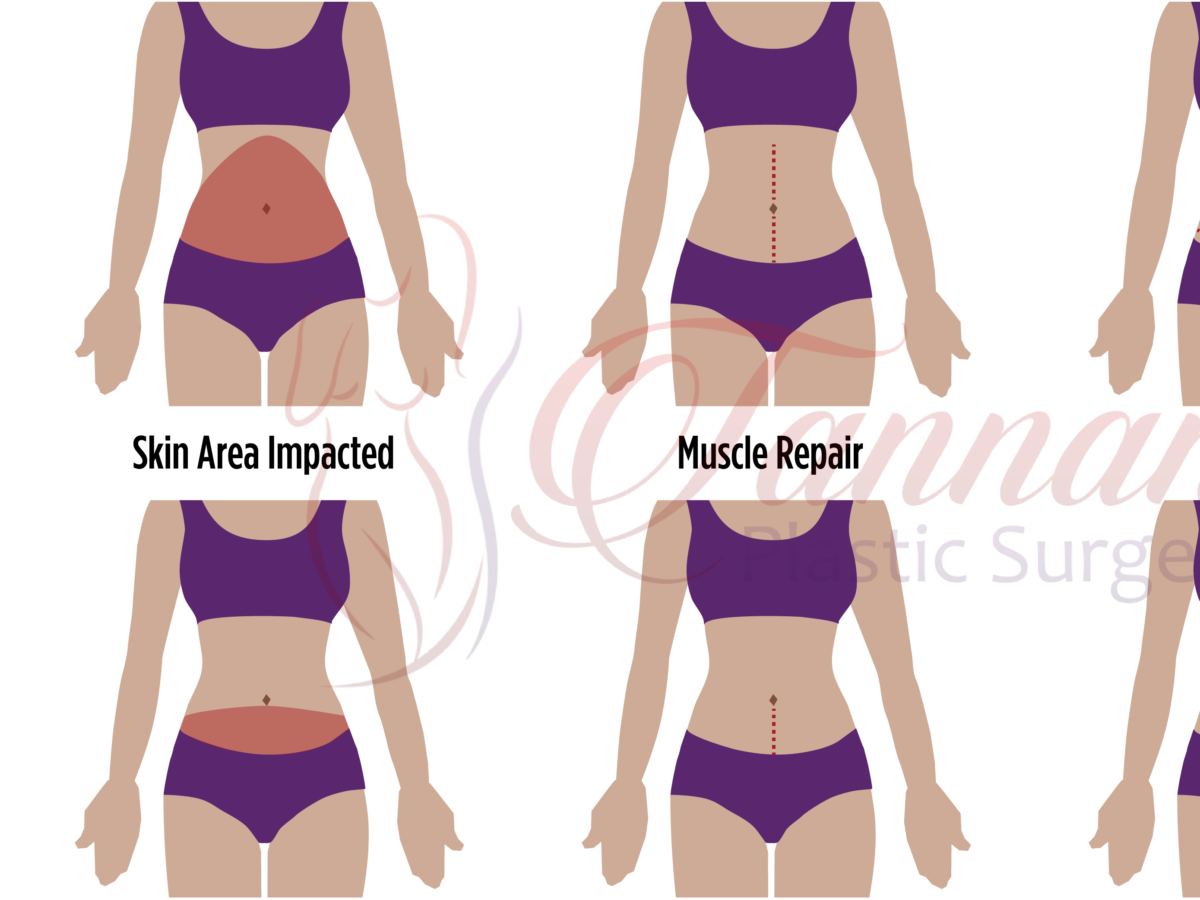 What Can I Do About My C-Section Scar and Pooch? - Tannan Plastic Surgery