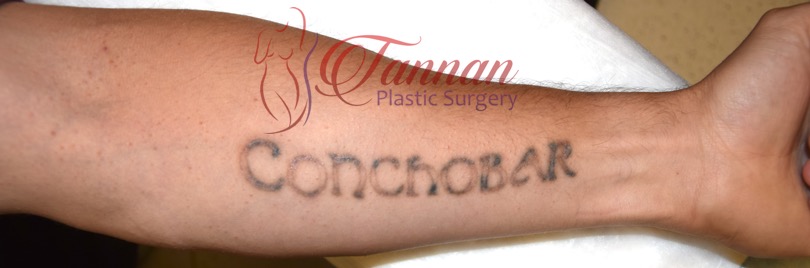 Tattoo Removal Before After 1a - Tannan Plastic Surgery