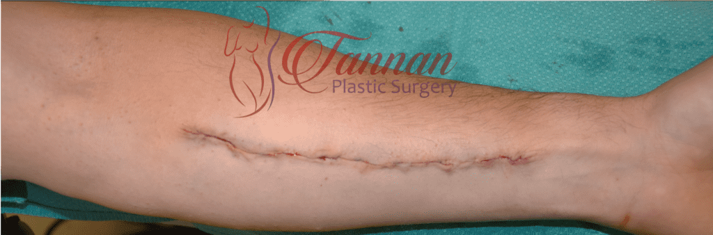 Tattoo Removal by Surgery