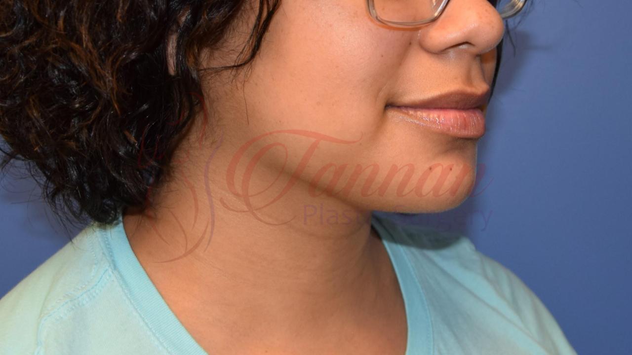 Submental Lipo After 1a – Tannan Plastic Surgery Submental Lipo After 1a - Tannan Plastic Surgery