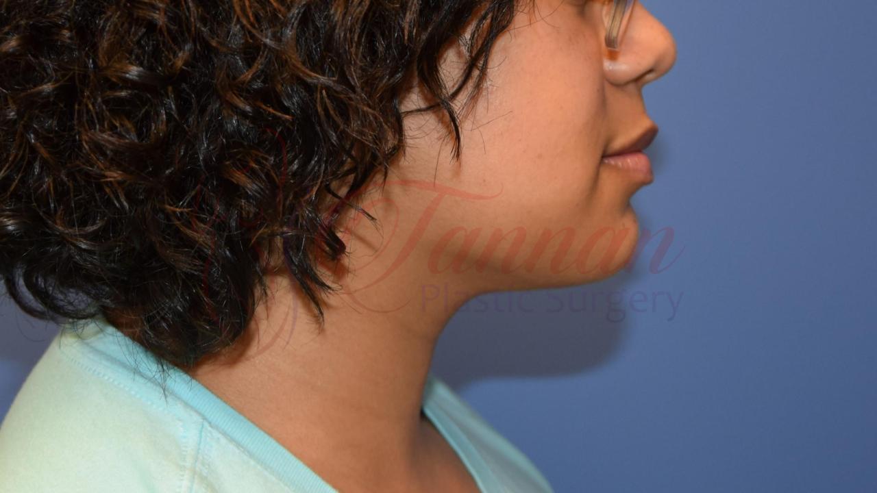 Submental Lipo After 1b – Tannan Plastic Surgery Submental Lipo After 1b - Tannan Plastic Surgery