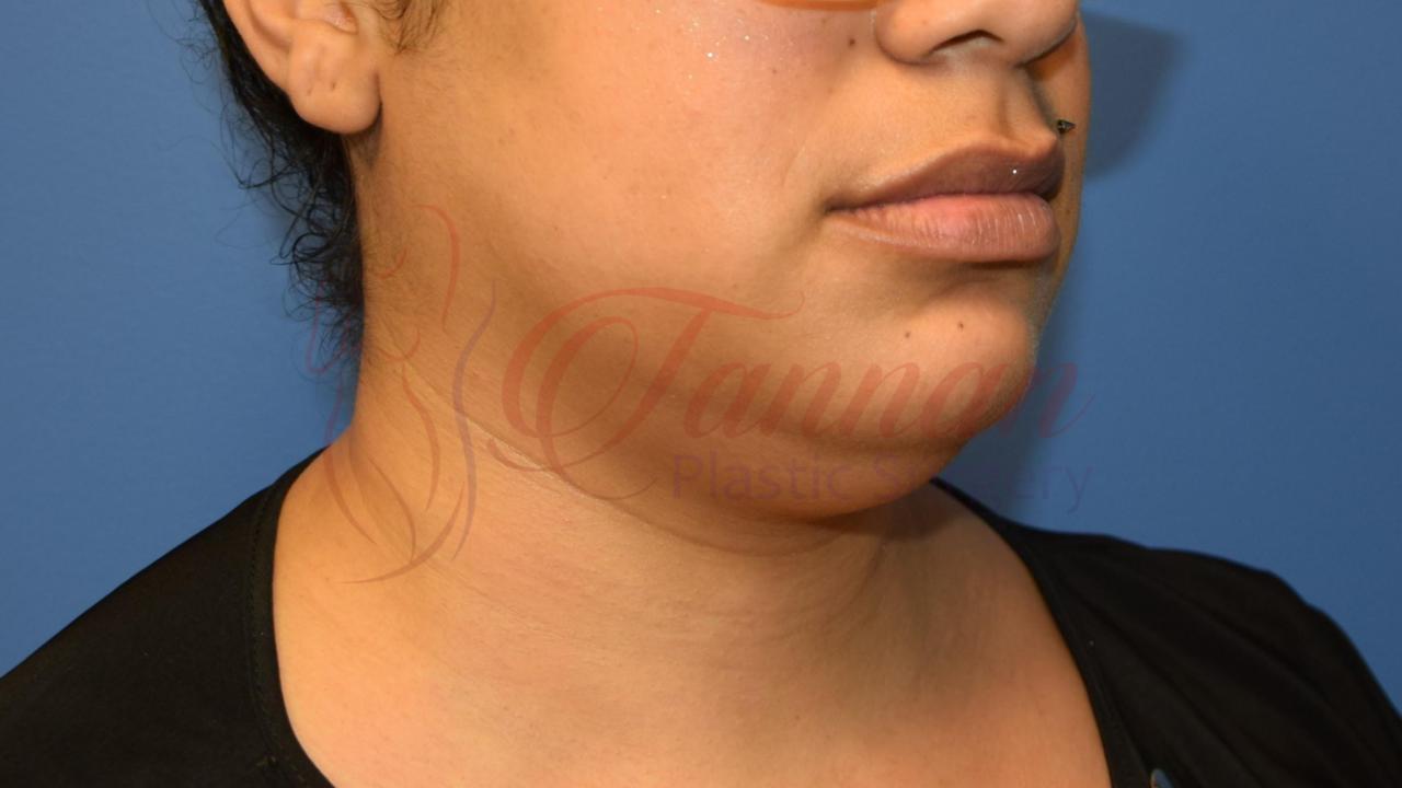 Submental Lipo Before 1a - Tannan Plastic Surgery