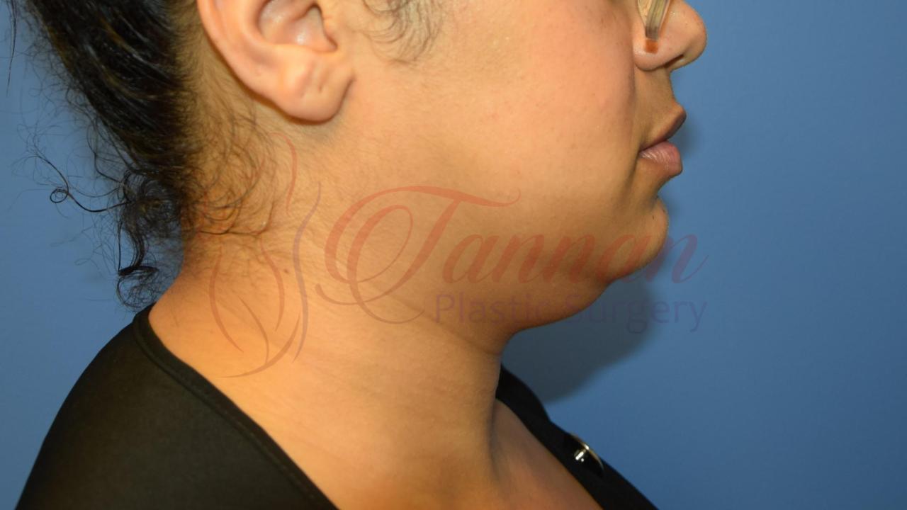 Submental Lipo Before 1b - Tannan Plastic Surgery