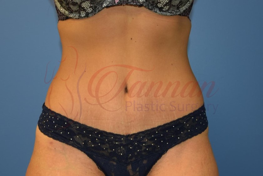 Tummy Tuck 1a AFTER - Tannan Plastic Surgery