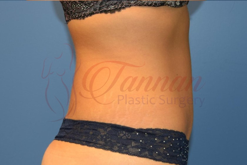 Tummy Tuck 1b AFTER - Tannan Plastic Surgery