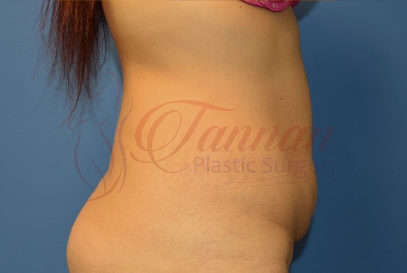 Tummy Tuck 1b BEFORE - Tannan Plastic Surgery