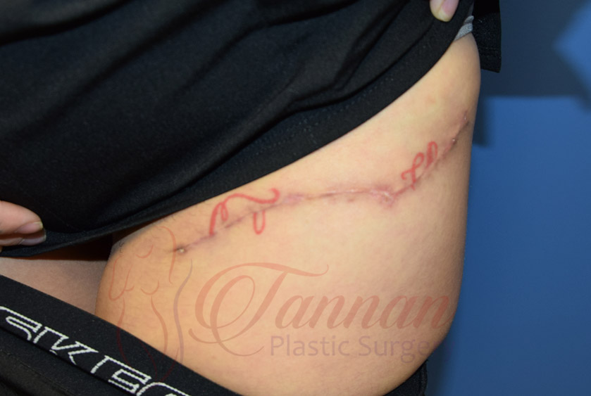 Tattoo Removal 1 AFTER - Tannan Plastic Surgery