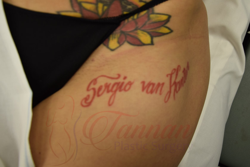 Tattoo Removal Before and After - Tannan Plastic Surgery