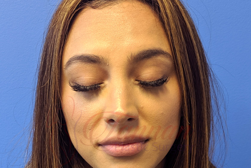 Newtox vs Botox AFTER - Tannan Plastic Surgery