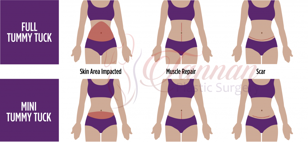 Mini Tummy Tuck Comparison - Tannan Plastic Surgery