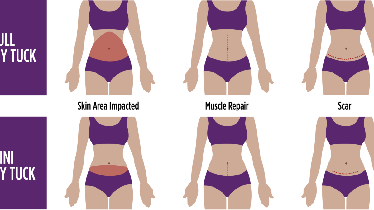 Everything You Need to Know About a Mini Tummy Tuck