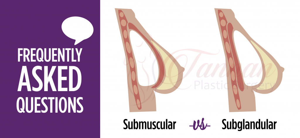 subglandular-vs-submuscular-comparison Subglandular -vs- Submuscular Implant Comparison - Tannan Plastic Surgery