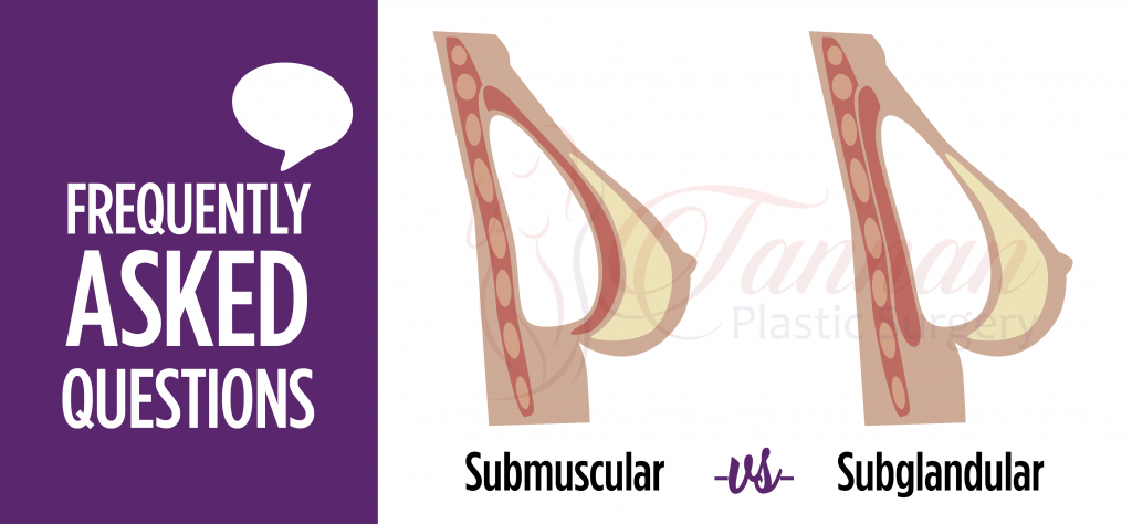 Subglandular -vs- Submuscular Implant Comparison - Tannan Plastic Surgery