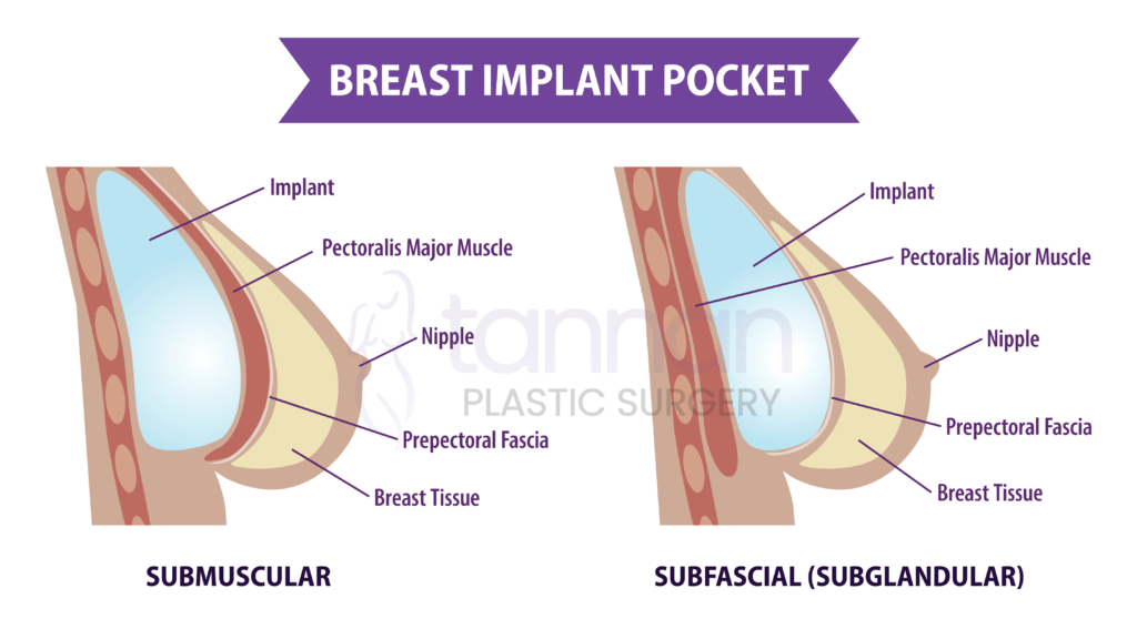 subglandular-vs-submuscular-labled-01 Subglandular -vs- Submuscular Implant Comparison Labeled - Tannan Plastic Surgery