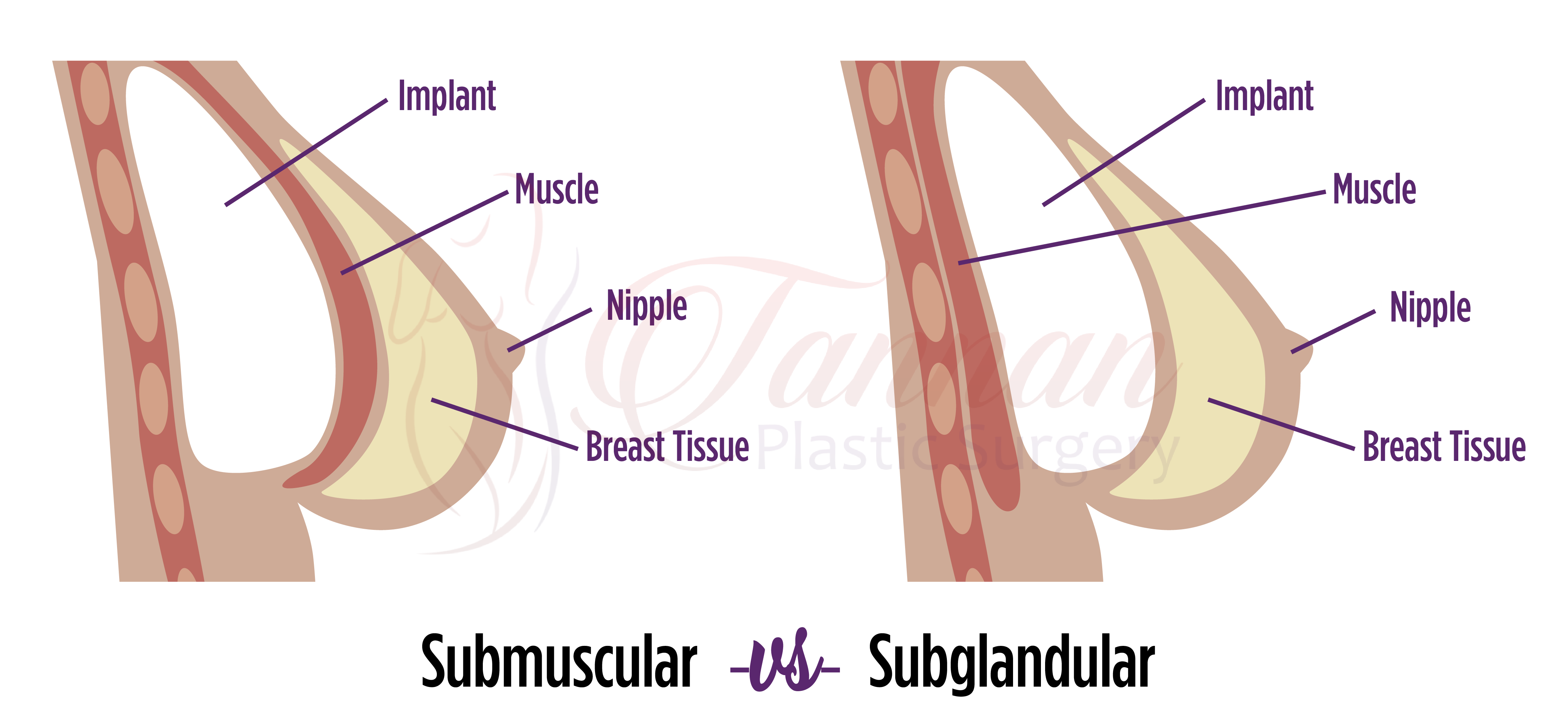 Subglandular -vs- Submuscular Implant Comparison Labeled - Tannan Plastic Surgery