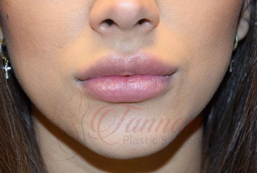 Virginia Lip Filler AFTER - Tannan Plastic Surgery