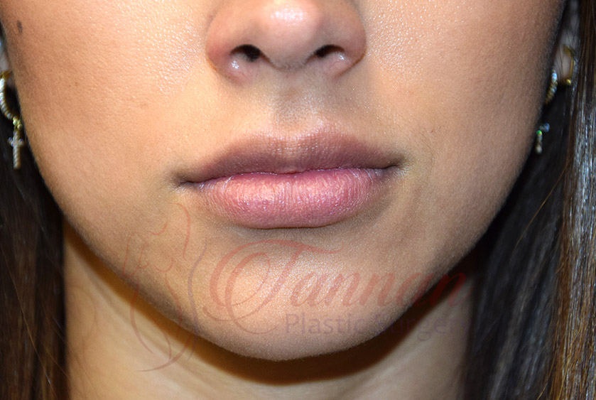 virginia-lip-filler-BEFORE Virginia Lip Filler BEFORE - Tannan Plastic Surgery