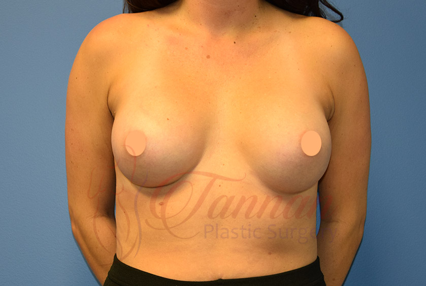 Breast-Implant-Size-AFTER Breast Implant Size After - Tannan Plastic Surgery