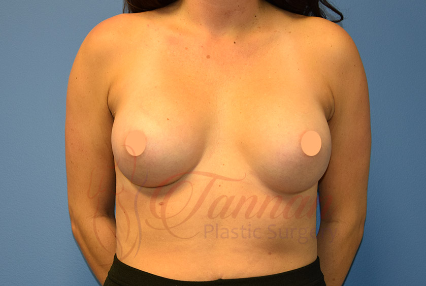 Breast Implant Size After - Tannan Plastic Surgery