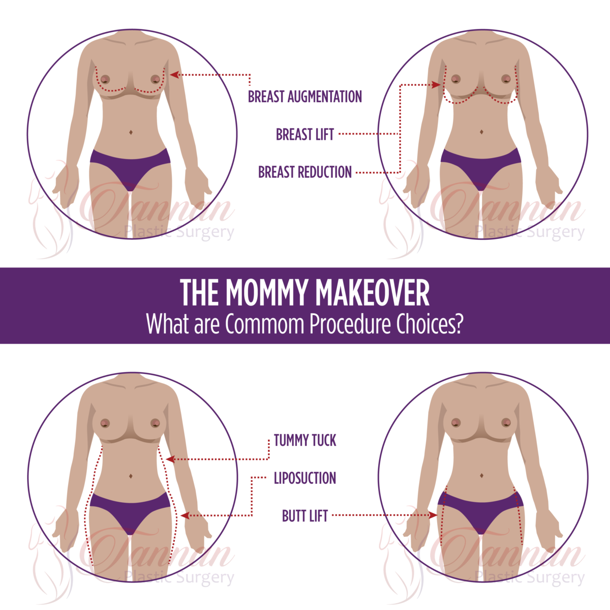 Mommy Makeover - Tannan Plastic Surgery
