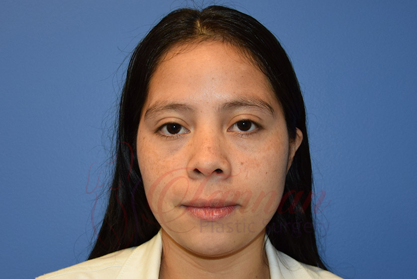 healthy-looking-skin-before-ZO Healthy Looking Skin Before ZO - Tannan Plastic Surgery