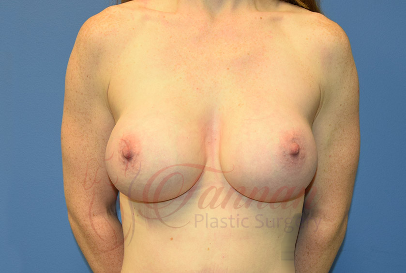 Breast-Augmentation-After-0101-Tannan-Plastic-Surgery