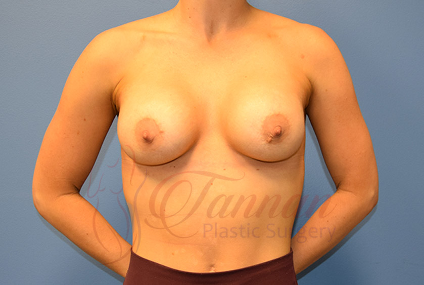 Breast-Augmentation-After-0901-Tannan-Plastic-Surgery