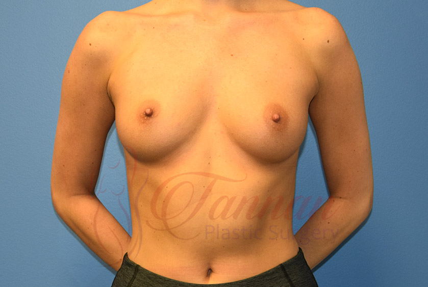 Breast-Augmentation-Before-1301-Tannan-Plastic-Surgery Breast-Augmentation-Before-1301-Tannan-Plastic-Surgery