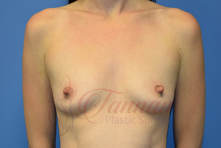 Breast-Augmentation-Before-1401-Tannan-Plastic-Surgery Breast-Augmentation-Before-1401-Tannan-Plastic-Surgery