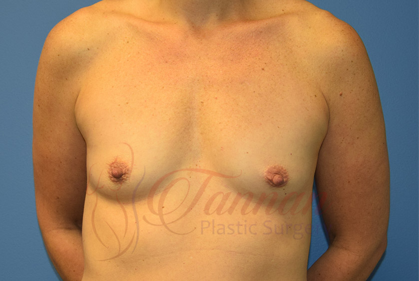 Breast-Augmentation-Before-1501-Tannan-Plastic-Surgery