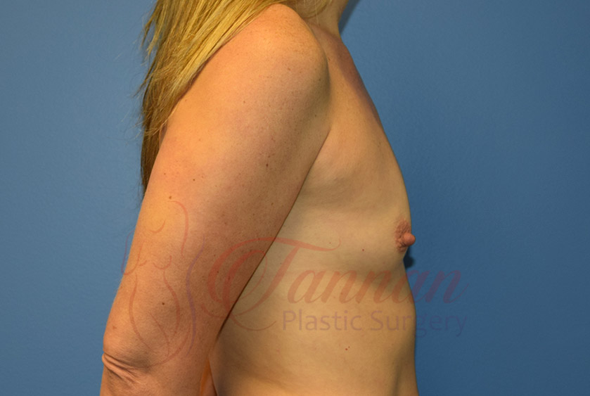 Breast-Augmentation-Before-1502-Tannan-Plastic-Surgery