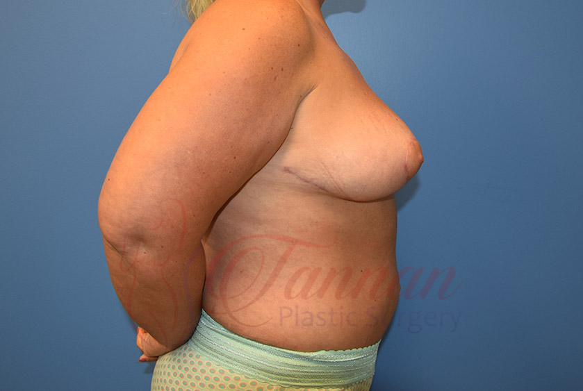 Breast-Reduction-After-0202-Tannan-Plastic-Surgery