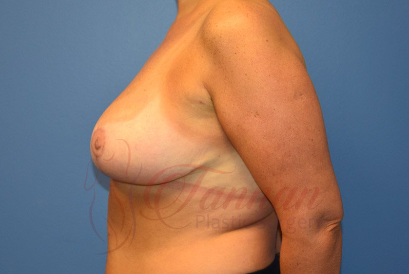 Breast-Reduction-After-0302-Tannan-Plastic-Surgery