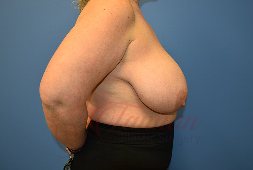 Breast-Reduction-Before-0202-Tannan-Plastic-Surgery