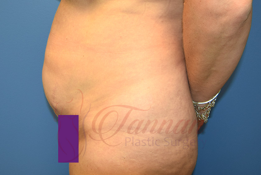 Tummy-Tuck-Before-0703-Tannan-Plastic-Surgery