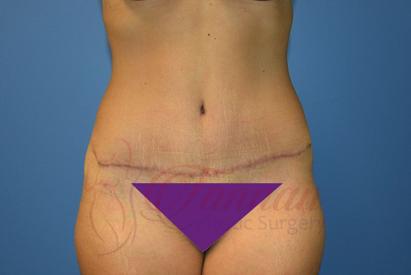 Tummy-Tuck-After-0101-Tannan-Plastic-Surgery