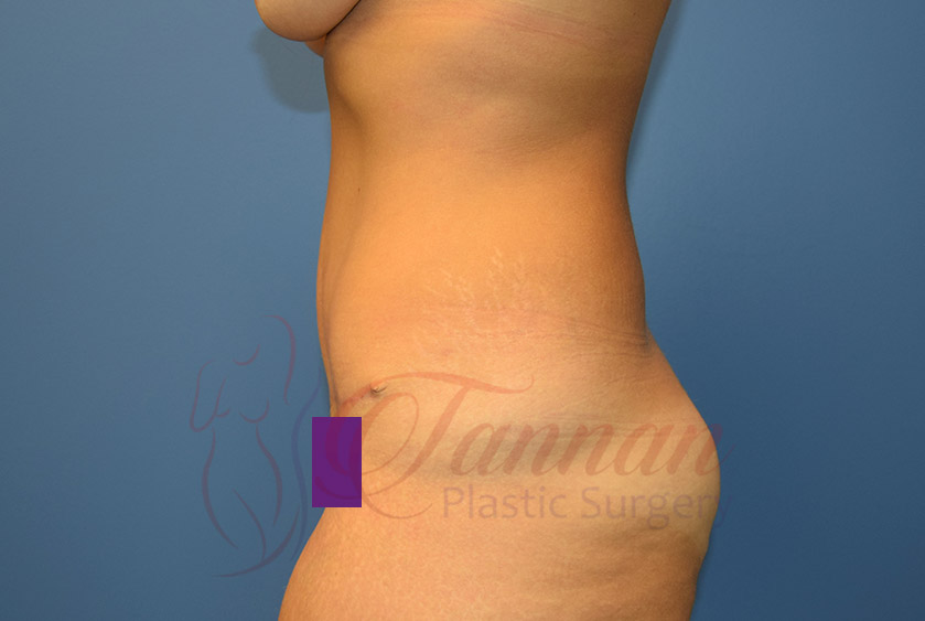 Tummy-Tuck-After-0102-Tannan-Plastic-Surgery