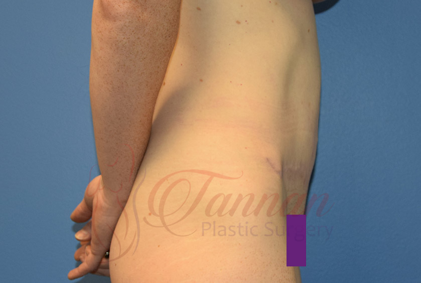 Tummy-Tuck-After-0202-Tannan-Plastic-Surgery