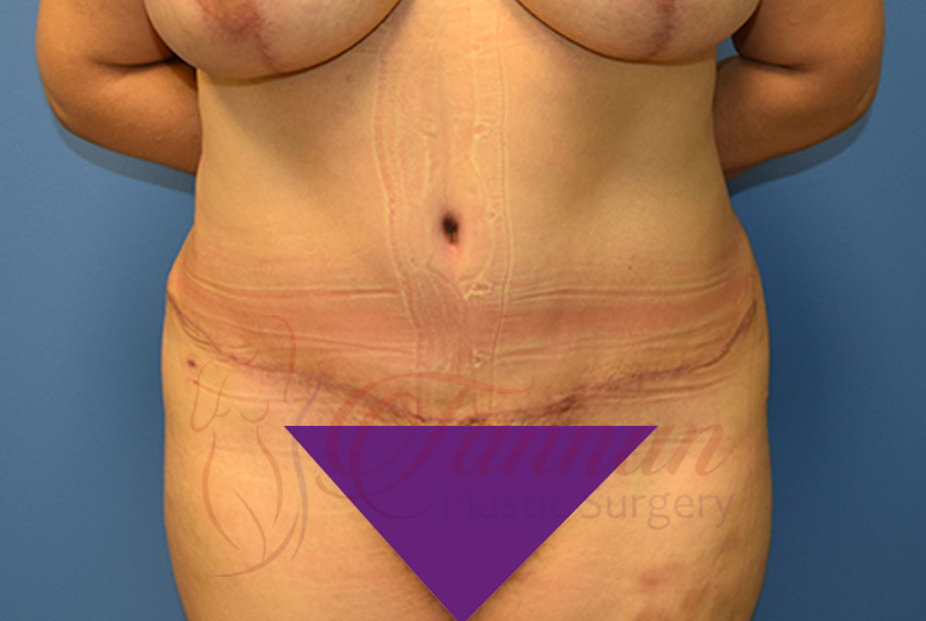 Tummy-Tuck-After-0301-Tannan-Plastic-Surgery