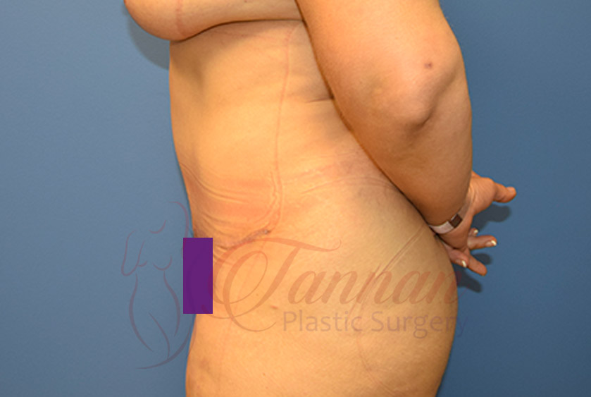 Tummy-Tuck-After-0302-Tannan-Plastic-Surgery