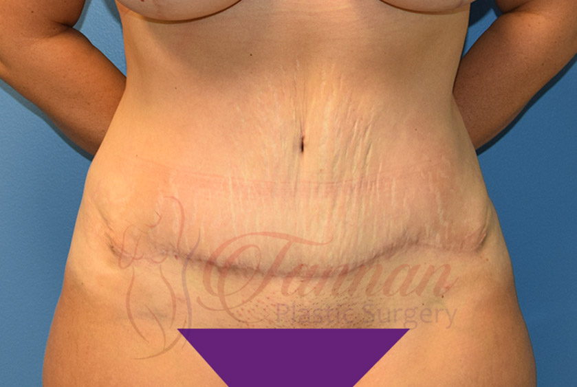 Tummy-Tuck-After-0401-Tannan-Plastic-Surgery