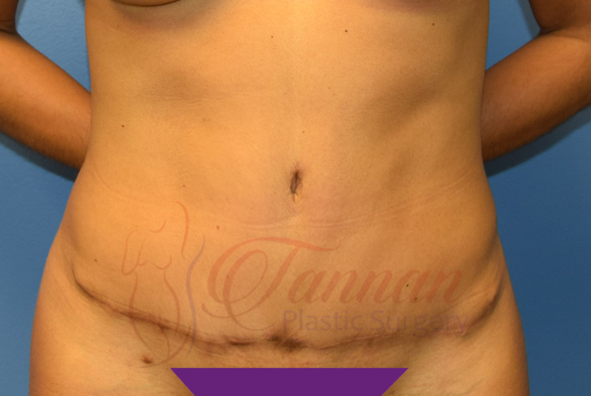 Tummy-Tuck-After-0501-Tannan-Plastic-Surgery