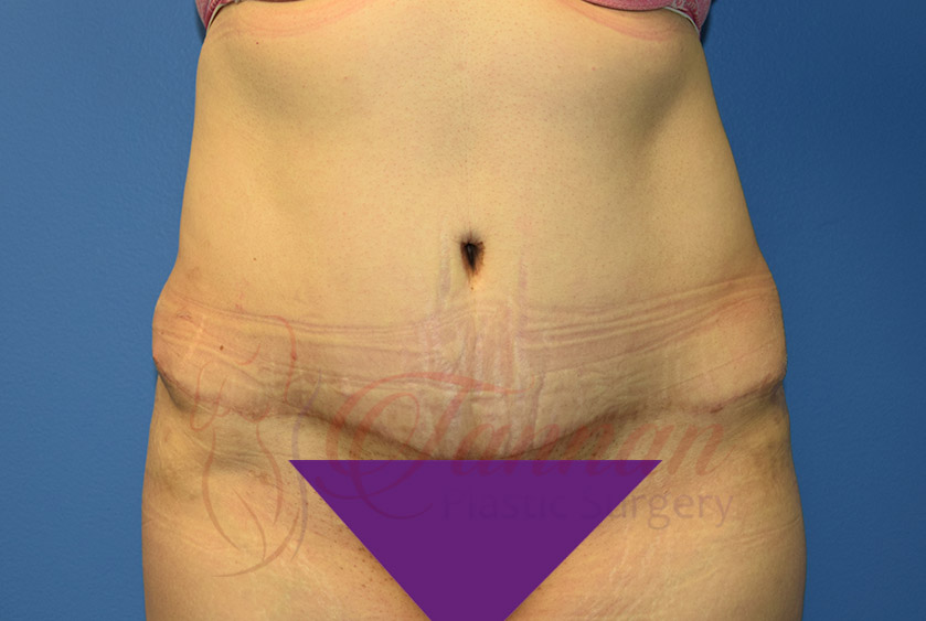 Tummy-Tuck-After-0601-Tannan-Plastic-Surgery