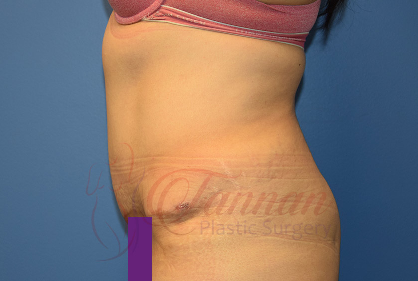 Tummy-Tuck-After-0602-Tannan-Plastic-Surgery