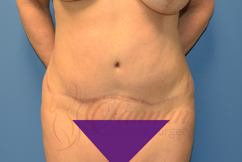 Tummy-Tuck-After-0701-Tannan-Plastic-Surgery