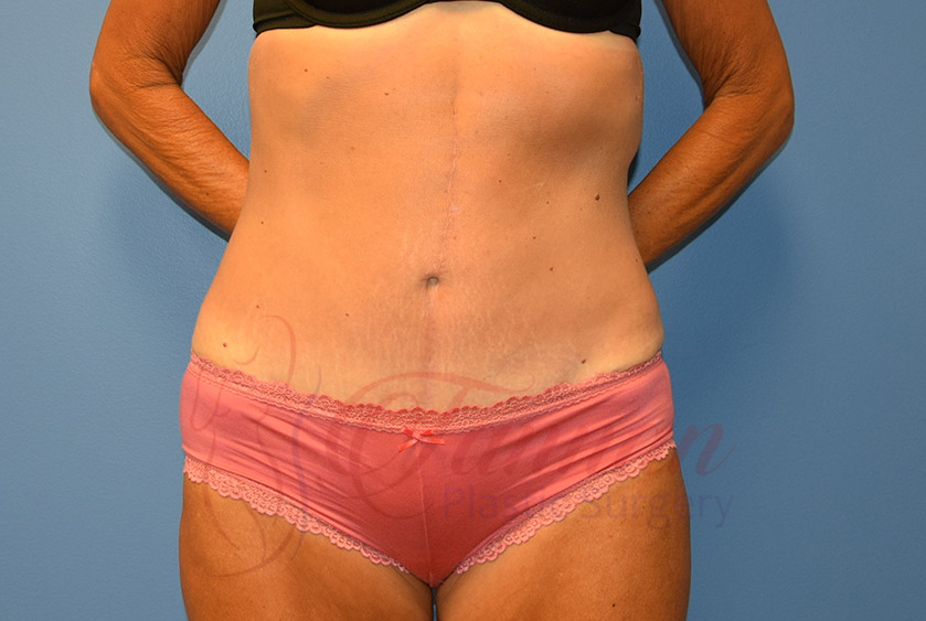 Tummy-Tuck-After-0801-Tannan-Plastic-Surgery