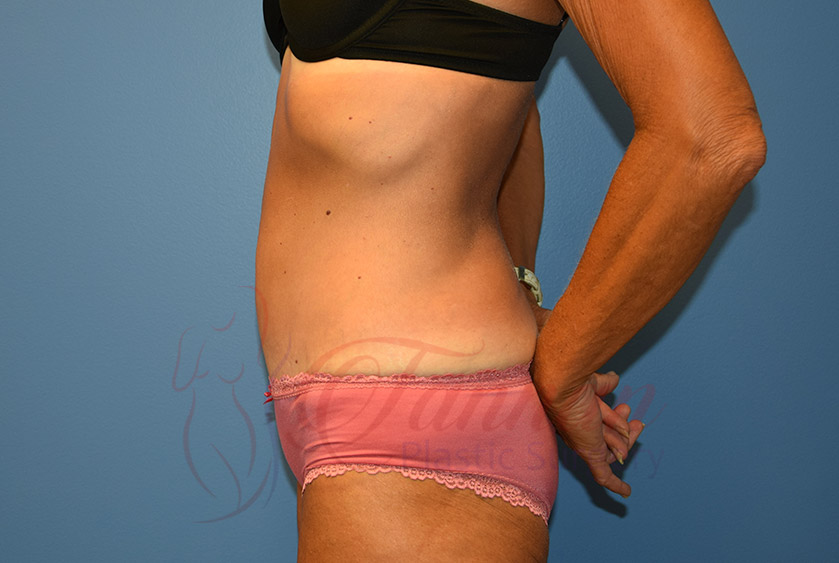 Tummy-Tuck-After-0802-Tannan-Plastic-Surgery